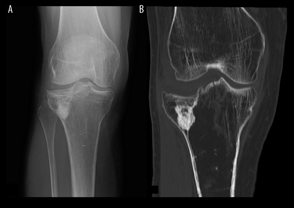 Fracture of the proximal tibia treated by bone substitute material augmentation. (A) Radiograph and (B) CT image following material removal.