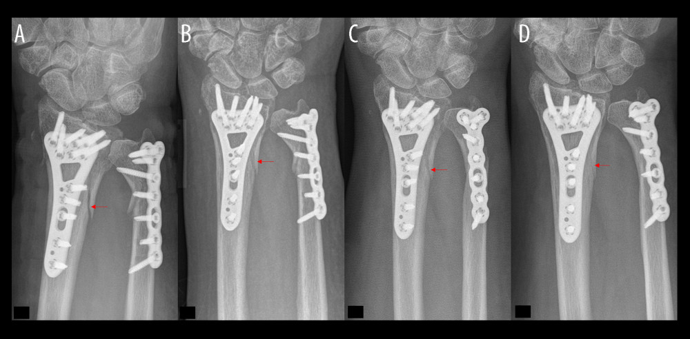 Distal forearm fracture treatment without bone defect augmentation demonstrates the bone healing process. (A) Plate osteosynthesis stabilized a fracture gap without bony filling. (B) Increased bone density in the first follow-up examination of the distal radius fracture. (C) In evaluating the bone healing process, fewer sharp bone edges were noticed. (D) Optimal interosseus integration demonstrate a slightly unclear edge and a fracture gap with bone density.
