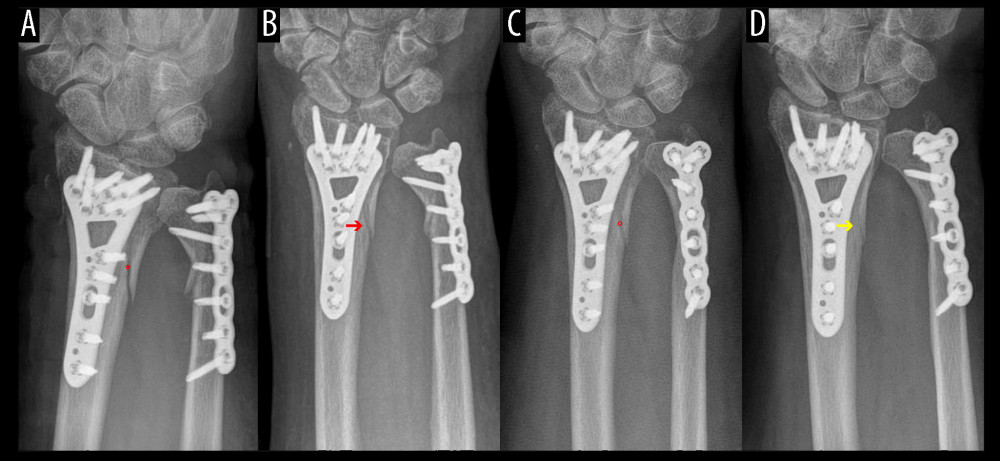 Follow-up (FU) examination demonstrating pattern of bone healing. (A) Border of fracture is sharply edged, with a (*) loss of density in the fracture gap. (B) Border of fracture with (red arrow) dimly visible edges and slightly increasing density of fracture gap. (C) Commencing consolidation with (°) increasing density in fracture gap. (D) Concentration of density in the ulnar part of fracture (yellow arrow) and maximal osseous integration in the radial part of fracture compared to previous examinations. A similar consolidation pattern was seen on the ulna.