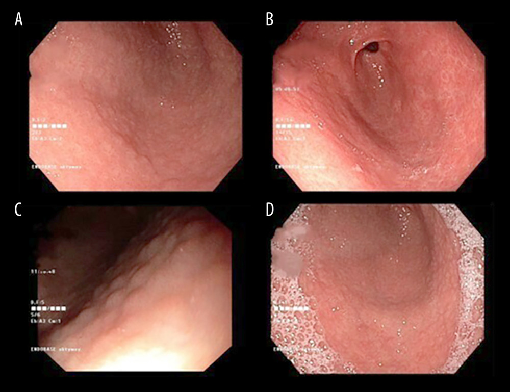 (A–D) Endoscopy images of the gastric mucosa of patients with H. pylori infection.