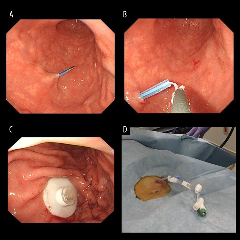 Endoscopic procedure for establishing a gastrostomy. The procedural sequence from an endoscopy to the placement of gastrostomy is shown in figure A–D).