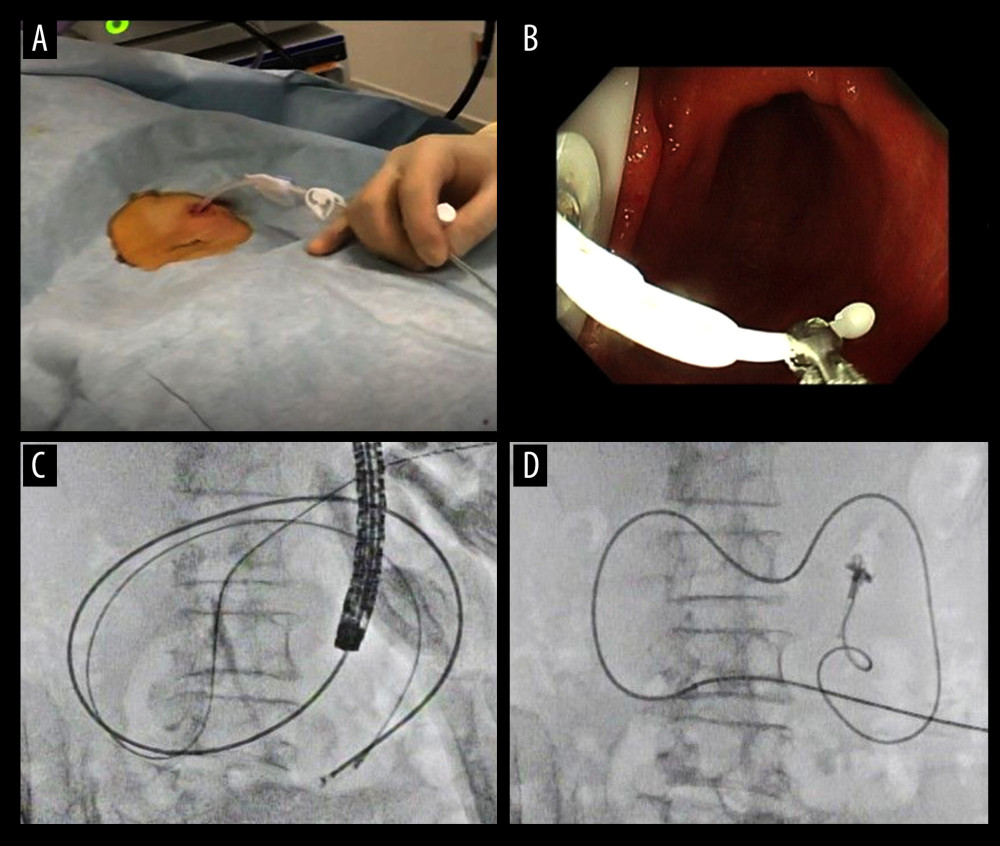 An appearance of endoscopic procedure for placing PEG-J tube under radioscopy. The procedural sequence from a gastrostomy to the placement of the PEG-J tube is shown in figure A–D).
