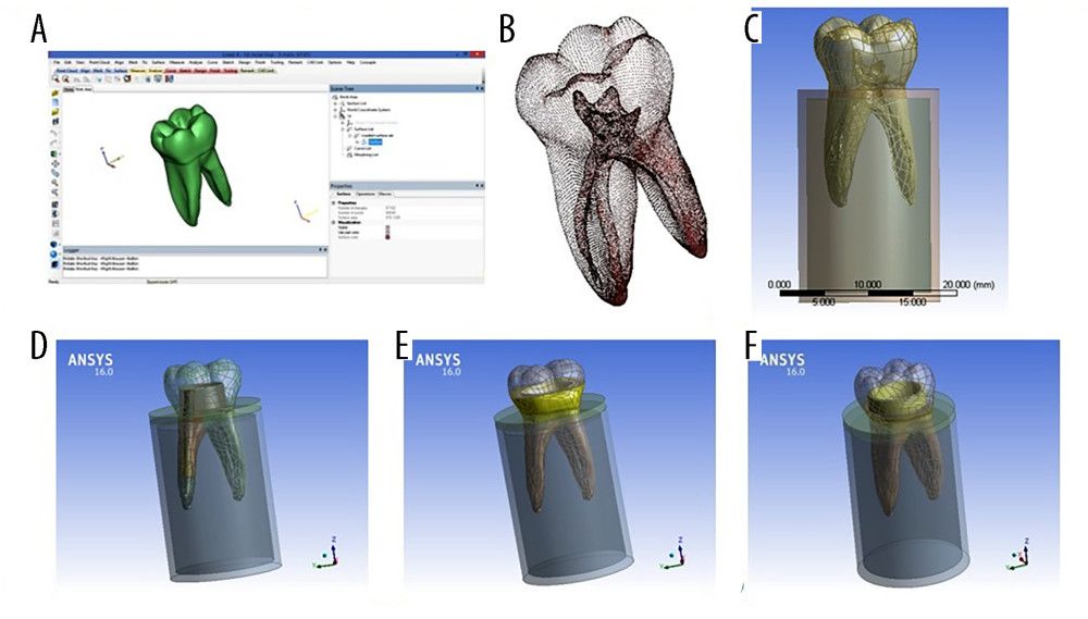 Models’ components during preparation (A) 3-matic screen during tooth extracting, (B) STL file points, (C) intact tooth inside bone cylinders, and the 3 final finite element models geometries; (D) post and core restoration, (E) endocrown butt joint margin, (F) endocrown with shoulder finish line. Software: 3-Matic (version 15.01, Materialize, NV, USA); software: ANSYS (version 16, ANSYS Inc., Canonsburg, PA, USA).