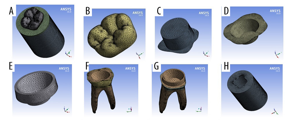 Final models meshed components from Ansys screen; (A) full model, (B) crown; (C) cement above core, (D) butt joint margin cement, (E) shoulder finish line cement, (F) remaining tooth under butt joint margin, (G) remaining tooth under shoulder finish line, (H) cortical bone. Software: ANSYS (version 16, ANSYS Inc., Canonsburg, PA, USA).