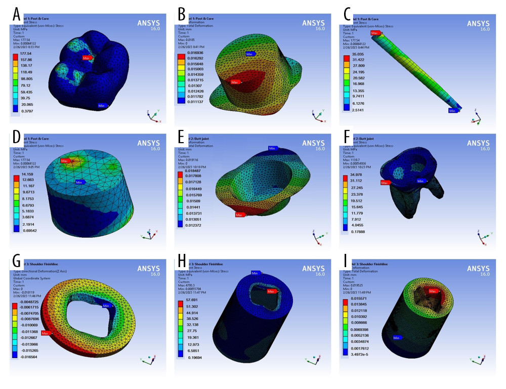 Sample results obtained during the vertical loading analyses; (A–D) model 1, (E, F) model 2, (H–I) model 3. Software: ANSYS (version 16, ANSYS Inc., Canonsburg, PA, USA).