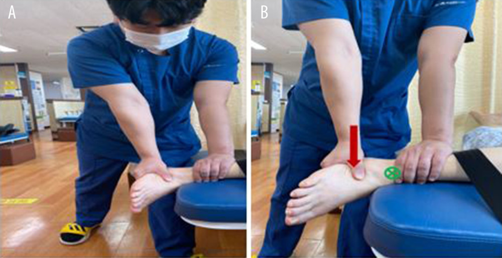Subtalar joint L-M mobilization. (A) L-M mobilization Grade III starting position (B) Glide direction by force when L-M mobilization is applied.