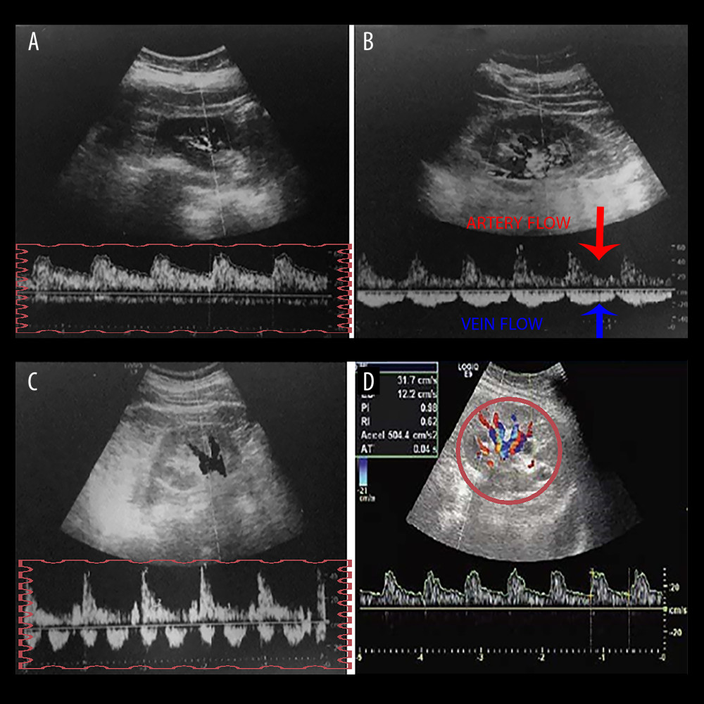 A graph showing intra-renal artery and vein flow through intra-renal artery Doppler ultrasonography. (A) Continuous venous flow pattern from intra-renal venous flow pattern. (B) The arrows show artery and vein flow in the intra-renal Doppler ultrasonography, and the pulsatile venous flow pattern is demonstrated. (C) The biphasic venous flow pattern is shown in the rectangle. (D) Graph showing intra-renal artery and vein flow. Microsoft Paint (Microsoft, Redmond, WA, USA).