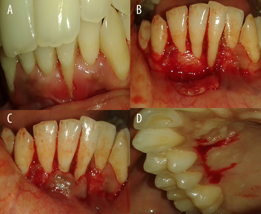 Gingival recession coverage with connective tissue graft. (A) Preoperative photograph of left mandibular lateral incisors (31); (B) incision for laterally repositioned flap; (C) checking flap approximation; and (D) harvesting connective tissue graft.