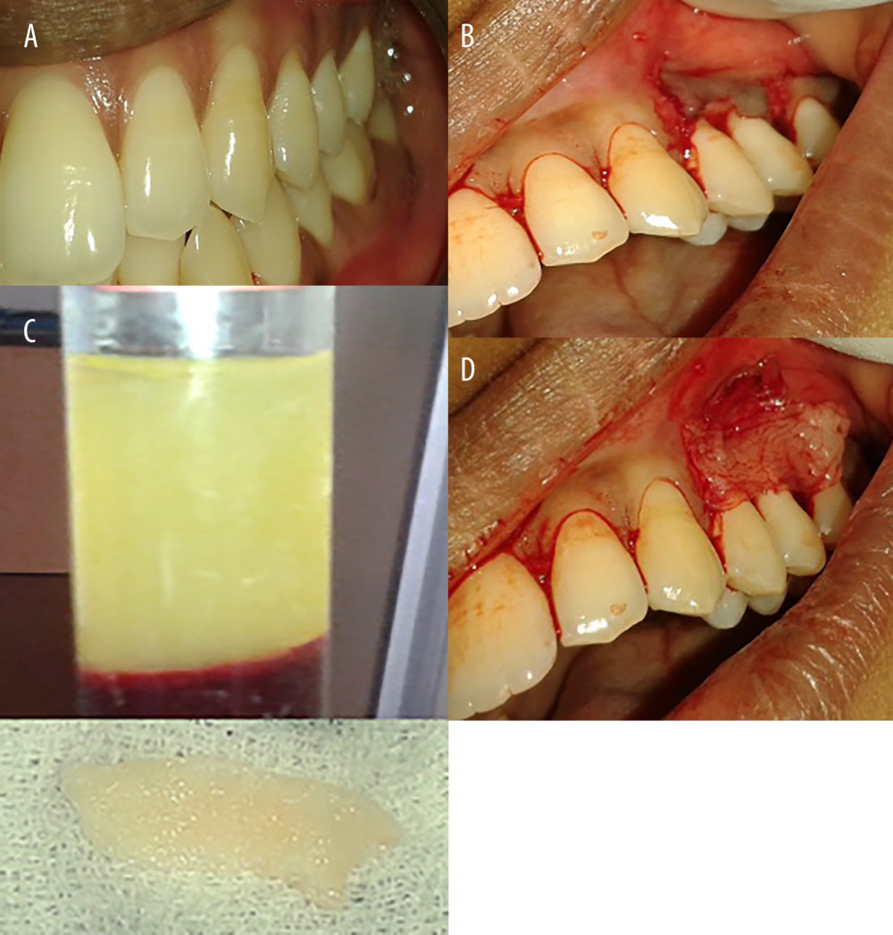 Gingival recession coverage with platelet-rich fibrin. (A) Preoperative photograph of left maxillary premolar, 24,25; (B) platelet-rich fibrin; (C) incision for laterally repositioned flap; and (D) placement of platelet rich fibrin on recipient bed.