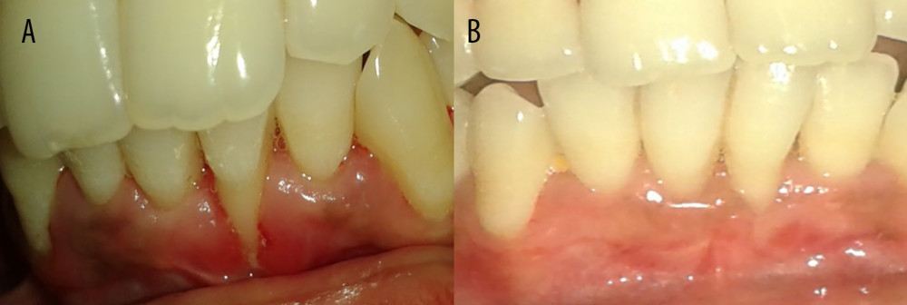 Preoperative and postoperative photographs of control group (connective tissue graft). (A) Preoperative photograph of left mandibular lateral incisor 31; (B) 1 year after surgery-31.