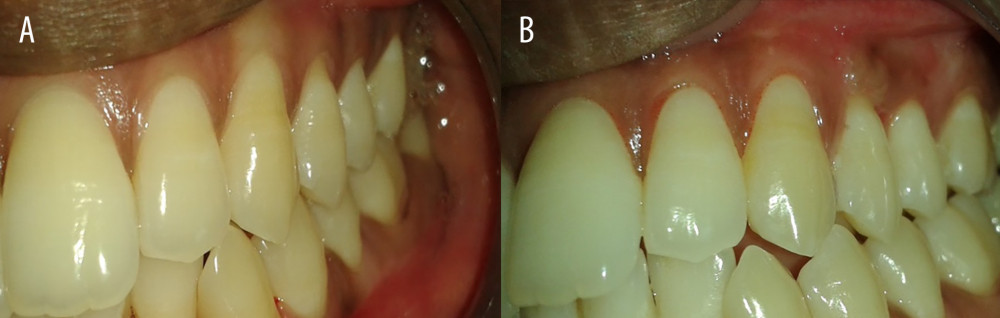 Preoperative and postoperative photographs of test group (PRF). (A) Preoperative photograph of left maxillary premolar −24,25; (B) 1 year after surgery of left maxillary premolar −24,25.