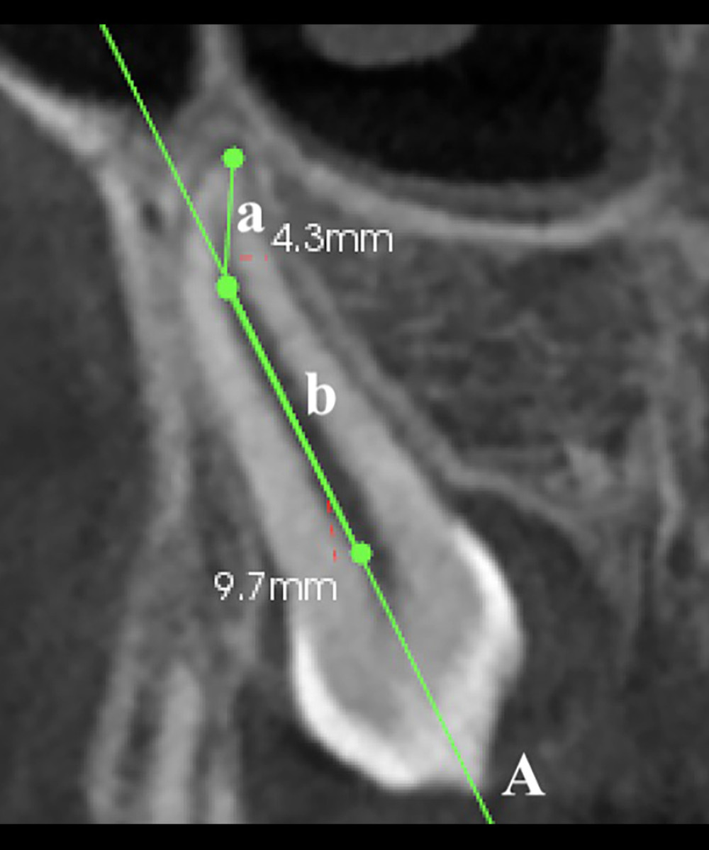 Measurement of dilacerated impacted canine root length. A) indicates the long axis of impacted canine tooth; a) indicates the length of the dilacerated part of the root (from root apex to the long axis of the tooth); b) indicates the length of straight part of the root (from the midpoint of the cementoenamel junction to starting point of the root curve). Total root length=a+b.