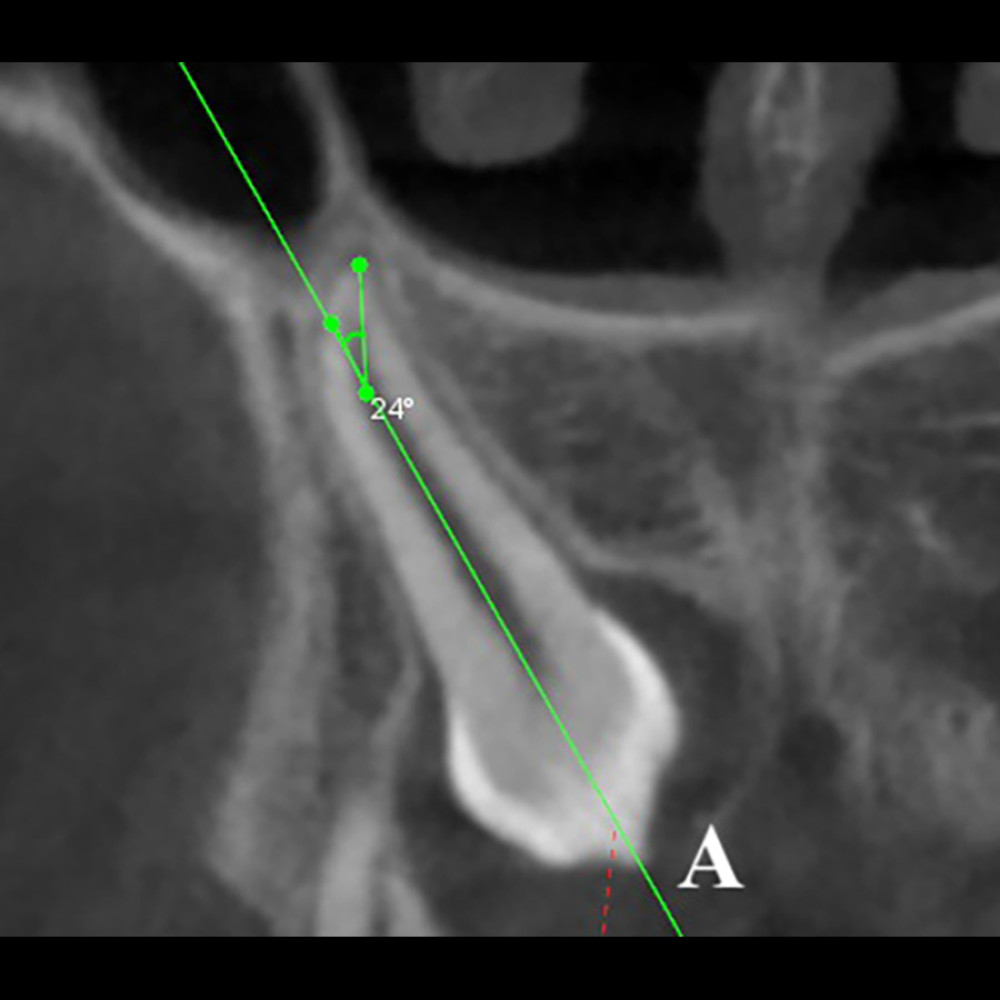 Measurement of the impacted canines root dilaceration angle. Line A indicates the long axis of the impacted canine.