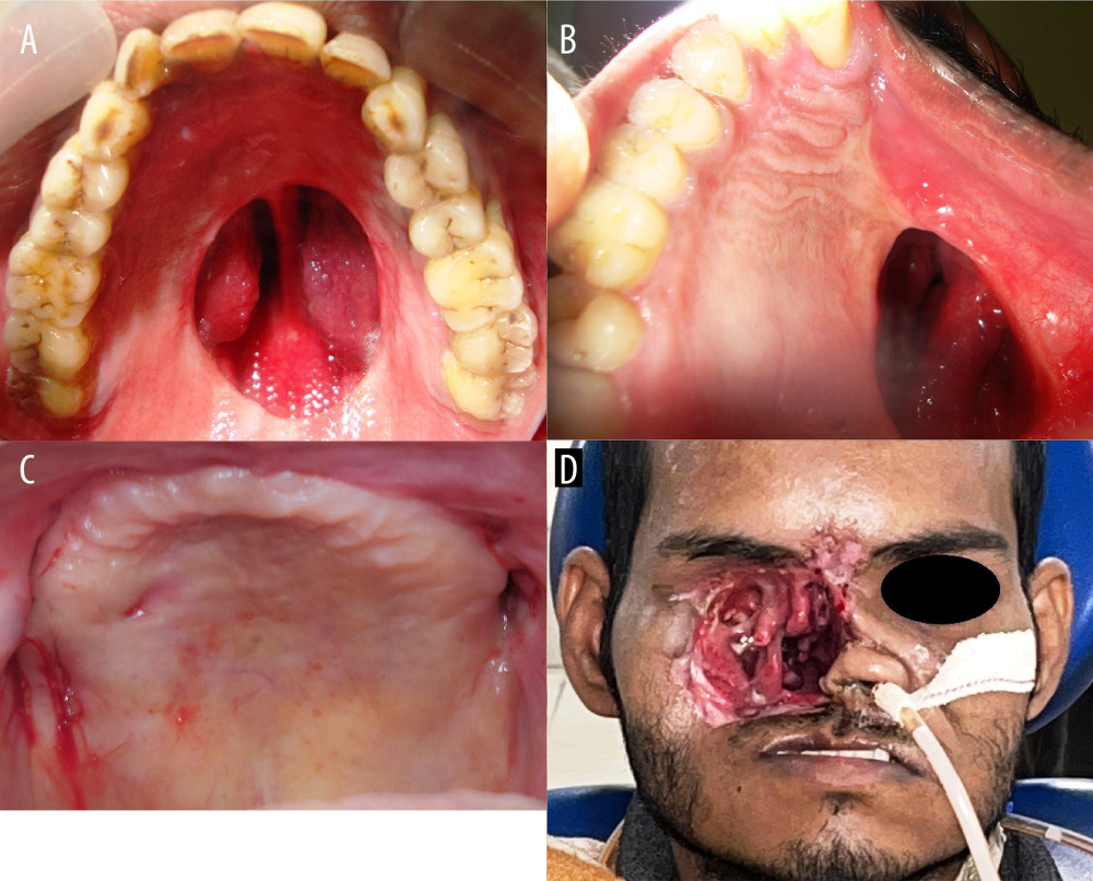 Exemplary cases involved in the study. (A) Subtotal maxillectomy bilateral (STM-B); (B) Total maxillectomy unilateral (STM-U) (note the depressed face on that side); (C) Total maxillectomy bilateral (TM-B) (note there is no hard palate on either side, the flap raised and then put back to prevent oro-nasal communication); (D) total maxillectomy with orbital exenteration unilateral (TMOE-U). Photographs taken using digital single-lens reflex (DSLR) camera (Canon EOS 700D) with 100 mm macro lens) with/without ring flash. Compiled Figure created using MS PowerPoint, version 20H2 (OS build 19042,1466), windows 11 Pro, Microsoft Corporation).