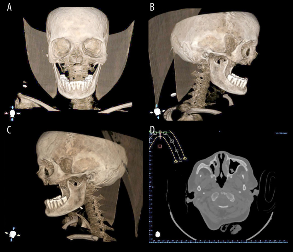 Diagnostic computed tomographic (CT scan) images of exemplary patient with bilateral maxillectomy. (A) Frontal view (note the maxillectomy extent); (B) Left lateral view; (C) Right lateral view; (D) Radiographic image during analysis. Photographs taken using digital single-lens reflex (DSLR) camera (Canon EOS 700D) with 100 mm macro lens) with/without ring flash. Compiled Figure created using MS PowerPoint, version 20H2 (OS build 19042,1466), windows 11 Pro, Microsoft Corporation).