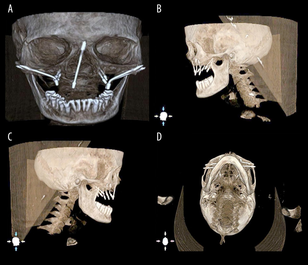 Different length zygomatic implant determination and placement on virtual DICOM (Digital Imaging and Communications in Medicine). (A) Frontal view; (B) Left lateral view; (C) right lateral view; (D) basal view. Note the length of the screw heads at the bone – implant interface level. Photographs taken using digital single-lens reflex (DSLR) camera (Canon EOS 700D) with 100 mm macro lens) with/without ring flash. Compiled Figure created using MS PowerPoint, version 20H2 (OS build 19042,1466), Windows 11 Pro, Microsoft Corporation).