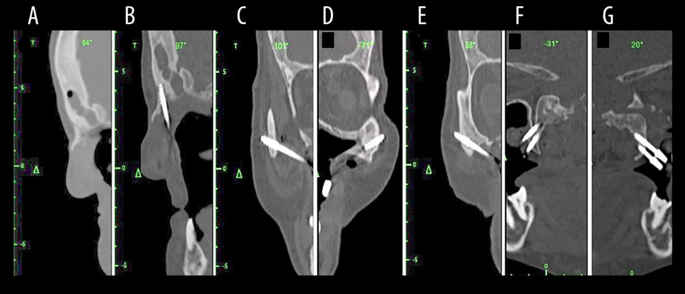 Preoperative display of the surgical planning for an exemplary maxillectomy patient planned to receive zygomatic implant on the navigation monitor. (A, B) Sagittal view before and after implant placement (C, D) on the left and right zygomatic bones (E–G) other views of planned areas. Photographs taken using a digital single-lens reflex (DSLR) camera (Canon EOS 700D) with 100 mm macro lens) with/without ring flash. Compiled Figure created using MS PowerPoint, version 20H2 (OS build 19042,1466), Windows 11 Pro, Microsoft Corporation).