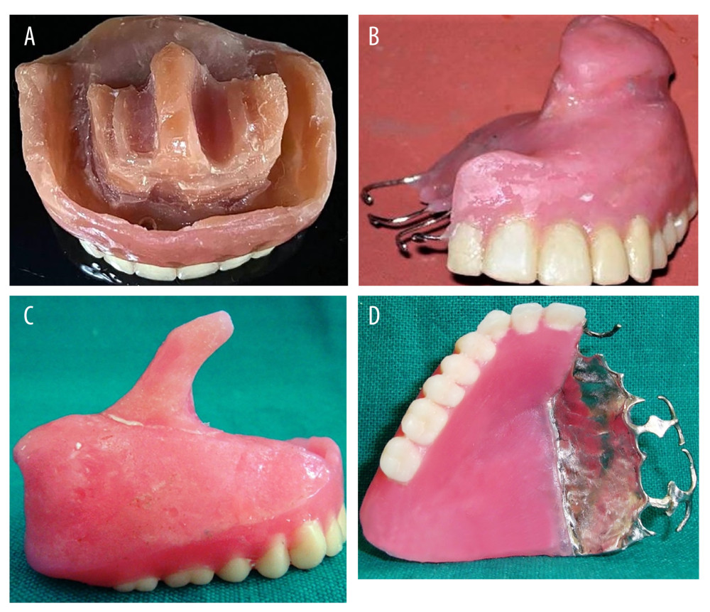 Types of prosthesis used in the total cohort. (A) Zygomatic implant-supported fixed complete denture prosthesis; (B) Interim obturator for unilateral total maxillectomy; (C) Interim obturator for subtotal maxillectomy; (D) Definitive prosthesis for total and subtotal maxillectomy cases. Photographs taken using a digital single-lens reflex (DSLR) camera (Canon EOS 700D) with 100 mm macro lens) with/without ring flash. Compiled Figure created using MS PowerPoint, version 20H2 (OS build 19042,1466), Windows 11 Pro, Microsoft Corporation).