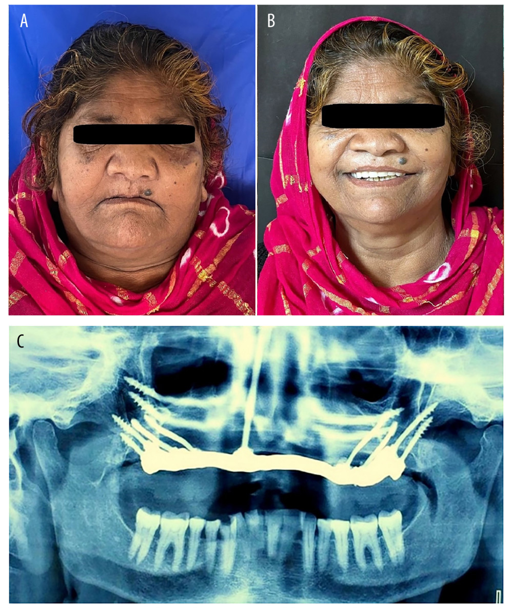 (A) Preoperative facial appearance of an exemplary patient showing facial aesthetics before prosthodontic rehabilitation; (B) Postoperative facial aesthetics with patient smiling; (C) 1 year follow-up orthopantomogram showing the zygomatic implant well received by the bone. Photographs taken using a digital single-lens reflex (DSLR) camera (Canon EOS 700D) with 100 mm macro lens) with/without ring flash. Compiled Figure created using MS PowerPoint, version 20H2 (OS build 19042,1466), Windows 11 Pro, Microsoft Corporation).
