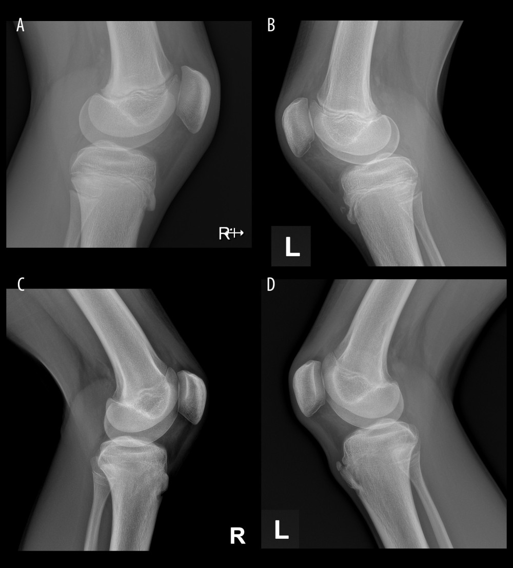 X-ray images belonging to the same patient: (A) healthy right knee; (B) left knee with separated bone fragment before PRP injection; (C) right knee after an observation period of 2 years; (D) left knee with separated bone fragment after PRP (Platelet-Rich Plasma) injection after observation period of 2 years.