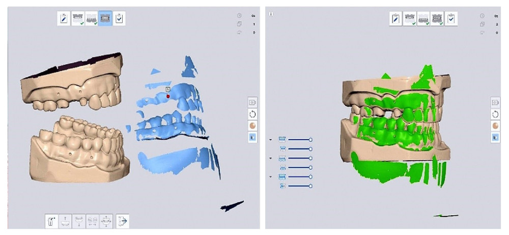 Digital articulation between the maxillary and mandibular digital casts showing the casts separated and in articulation position after using the manual alignment tool in the software (Medit Link). Compiled Figure created using MS PowerPoint, version 20H2 (OS build 19042,1466), windows 11 Pro, Microsoft corporation).
