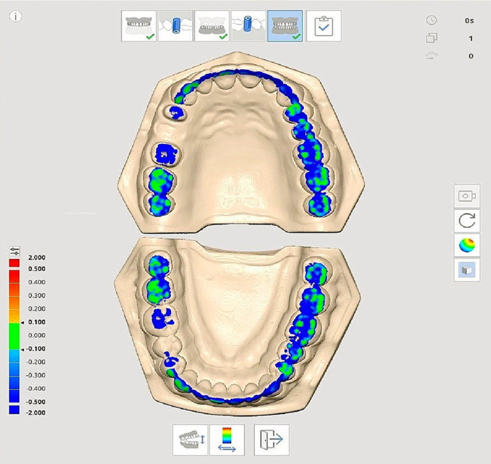 Digital occlusal analysis of articulated exemplary master model using Occlusal Analysis tool (Medit Link software) [Color green indicates occlusal contacts and the degree of occlusal contact (pressure) while blue indicates no contact. Compiled Figure created using MS PowerPoint, version 20H2 (OS build 19042,1466), windows 11 Pro, Microsoft corporation).