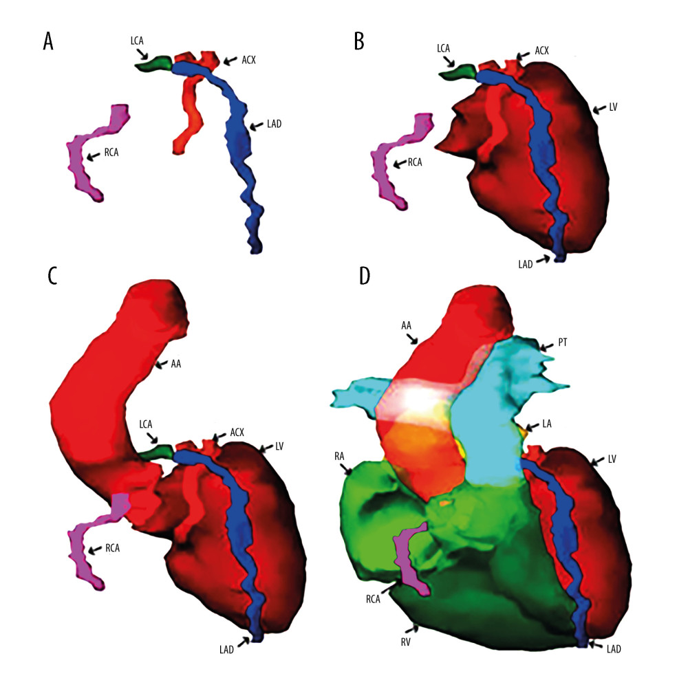 (A) Three-dimensional reconstruction of the main arteries of the coronary vascular system: the left coronary artery (LCA), the right coronary artery (RCA), the left anterior descending artery (LAD), and the anterior circumflex artery (ACX). (B) Anatomical relationships of the coronary vasculature to the left ventricle walls (LV). (C) Three-dimensional reconstruction of the emergence of the coronary vasculature from the ascending aorta (AA). (D) Three-dimensional reconstruction of the walls of the 2 left (LV) and right (RV) ventricles together with the most voluminous vascular pathways – ascending aorta (AA) and pulmonary trunk (PT) – and coronary vasculature. Reconstruction was performed in Varian Eclipse version 10 (2012).