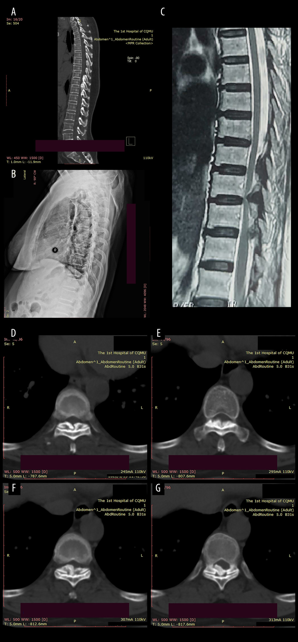 Preoperative imaging data of the patient:(A) Sagittal CT revealed a high-density mass protruding into the spinal canal at the levels of T8–T10, indicating potential spinal cord compression; (B) Preoperative sagittal X-ray of the patient; (C) The MRI plain scan revealed significant stenosis of the spinal canal at the corresponding levels of T8–T10, accompanied by marked compression and narrowing of the adjacent thoracic cord; (D–G) The coronal CT plain scan at T8–10 level revealed high-density ossification that had ruptured into the spinal canal, resulting in significant narrowing of the corresponding canal.