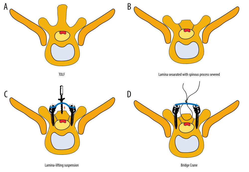 Medical Science Monitor LaminaLifting Suspension Modification in