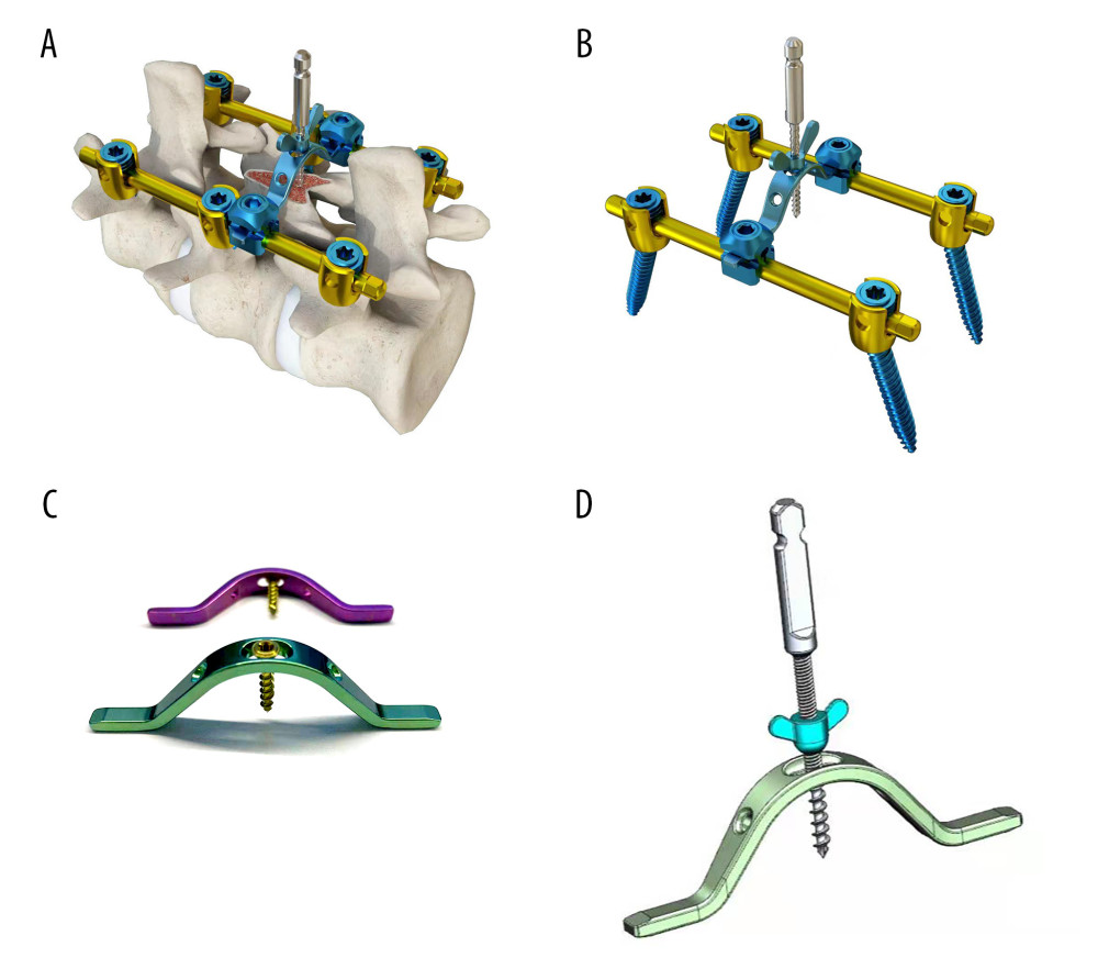 Local structure of the laminae-lifting suspension system.(A) Surgical 3D diagram of the laminae-lifting suspension system. (B) Local structure diagram of the laminae-lifting suspension system. (C, D) Local construction of the cross-bridge.