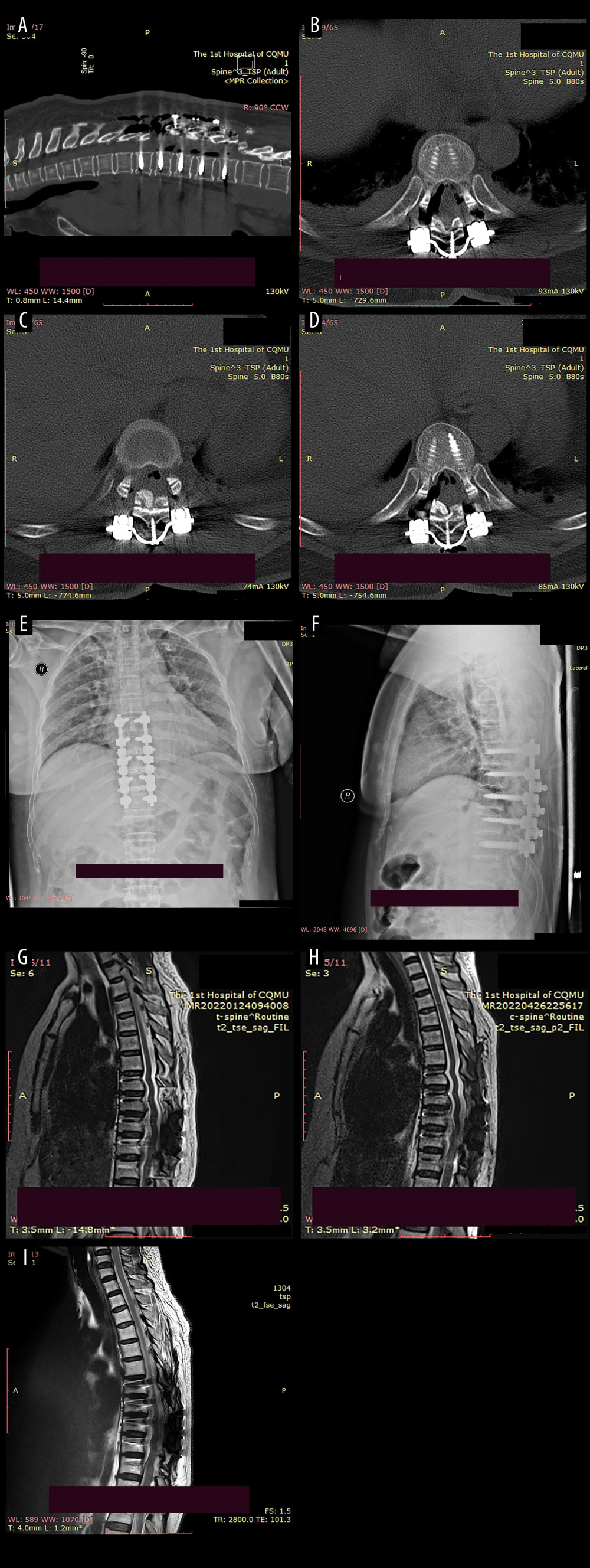 Postoperative imaging data of the patient.(A) The postoperative CT scan revealed a posterior shift of the ossifications and restoration of canal volume. The red area indicates the laminae-OLF complex (LOC). (B) Cross-bridge and screws in T8/T9. (C) Cross-bridge and screws in T9/T10. (D) Cross-bridge and screws in T10/T11. (E, F) Postoperative radiographs of the patient indicated local internal fixation and cross-bridges are in place without deviation. (G–I) MRI scans at 1 week, 3 months, and 1-year after surgery revealed a posterior migration of ossifications, with no abnormal signals detected in the spinal cord.