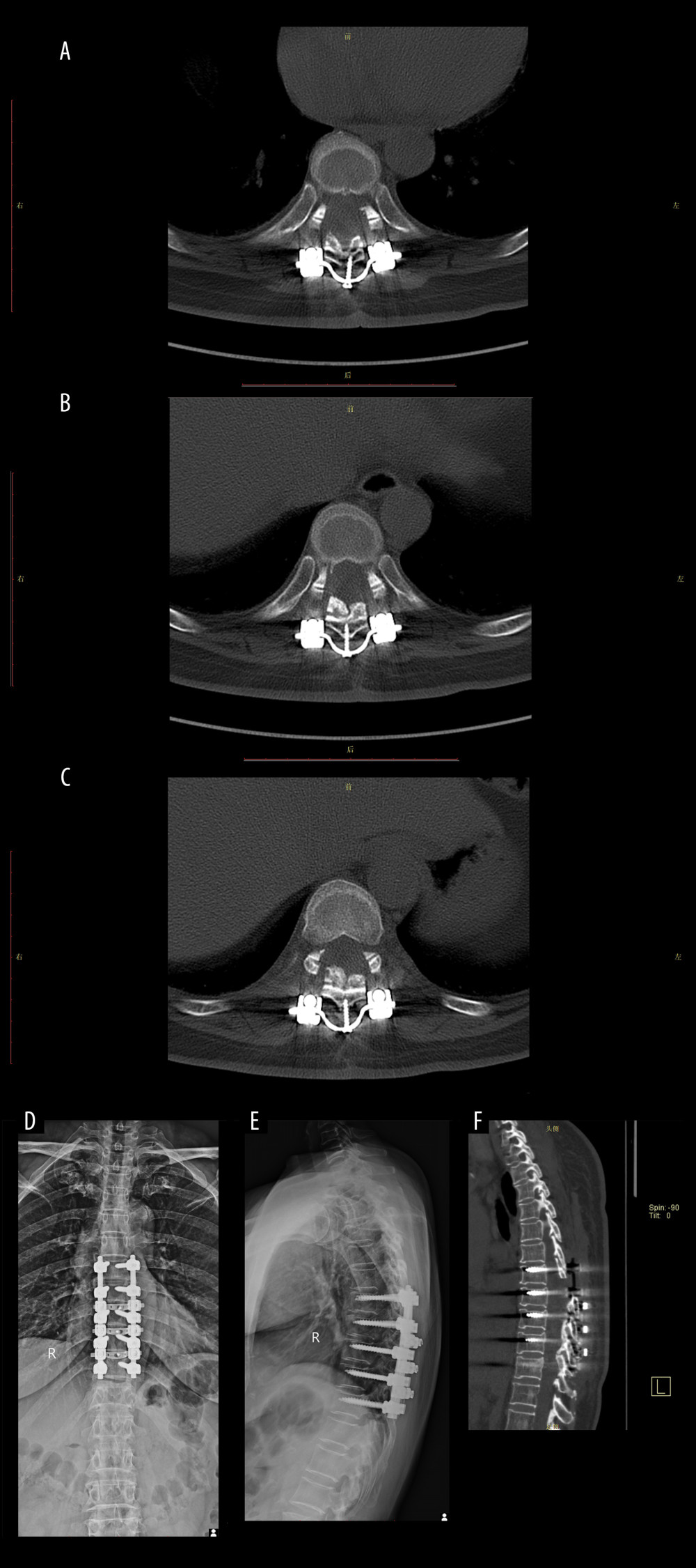 Imaging data of the patient after 6 months of follow-up.(A) Cross-bridge and screws in T8/T9. (B) Cross-bridge and screws in T9/T10. (C) Cross-bridge and screws in T10/T11. (D, E) Plain radiography of the spine showed screws, rods, and cross-bridge were still all in good position during the follow-up. (F) The sagittal sections of a CT scan.