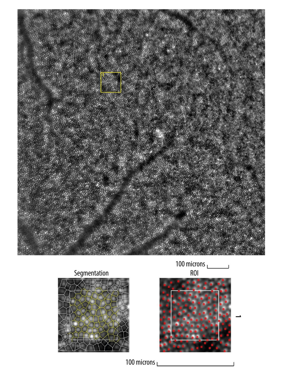 Image of normal cone mosaicImage of normal cone mosaic in a healthy volunteer obtained with adaptive optics camera 4°×4° degree square (Rtx-1, Imagine Eyes, Orsay, France). The analysis was performed at superior 2° from the fovea (top). The region of interest (ROI) (yellow square in the top image) was used for automated cone segmentation (bottom left) and detection (bottom right) using dedicated software. Red squares correspond to automatically identified cones (bottom right). The image is from the author’s collection.