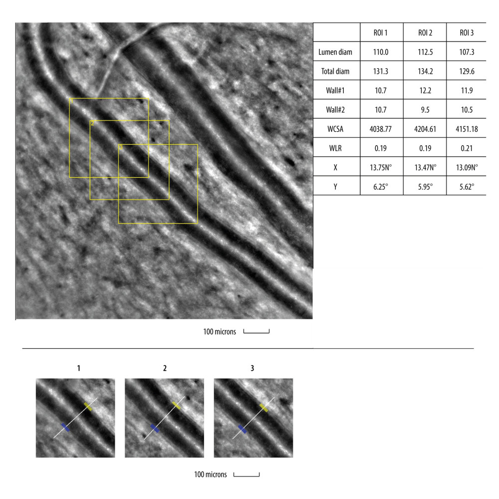 Image of normal retinal arteriole and venuleEvaluation of retinal arteriolar morphology in a healthy volunteer with adaptive optics camera 4°×4° degree square (Rtx-1, Imagine Eyes, Orsay, France) and measurement of morphological parameters using AOdetect software (top). The parameters calculated from the 3 selected regions of interest, for each time landmark (100 μm width and height each) (bottom). The image is from the author’s collection.
