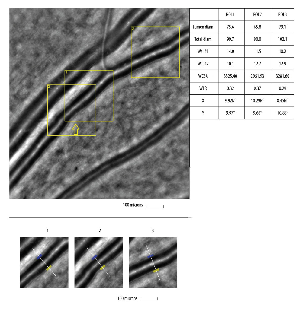 Image of retinal vessels in a patient with diabetes mellitus type 2Evaluation of retinal arteriolar morphology in a patient with diabetes mellitus type 2 with adaptive optics camera 4°×4° degree square (Rtx-1, Imagine Eyes, Orsay, France) and measurement of morphological parameters using AOdetect software. Retinal artery with focal luminal narrowing (yellow arrow) and increased wall-to-lumen ratio (WLR 0,33; 0,37; 0,29) (top). The parameters calculated from the 3 selected regions of interest, for each time landmark (100 μm width and height each) (bottom). The image is from the author’s collection