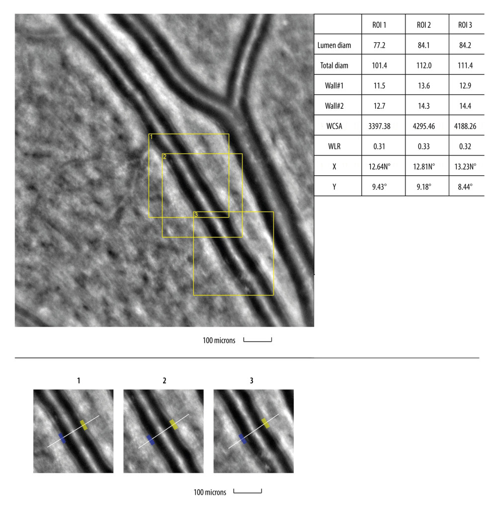 Image of retinal vessels in a patient with hypertensive retinopathyEvaluation of retinal arteriolar morphology in a patient with hypertensive retinopathy with adaptive optics camera 4°×4° degree square (Rtx-1, Imagine Eyes, Orsay, France) and measurement of morphological parameters using AOdetect software. Retinal artery with increased wall-to-lumen ratio (WLR 0,31; 0,33; 0,32) (top). The parameters calculated from the 3 selected regions of interest, for each time landmark (100 μm width and height each) (bottom). The image is from the author’s collection.