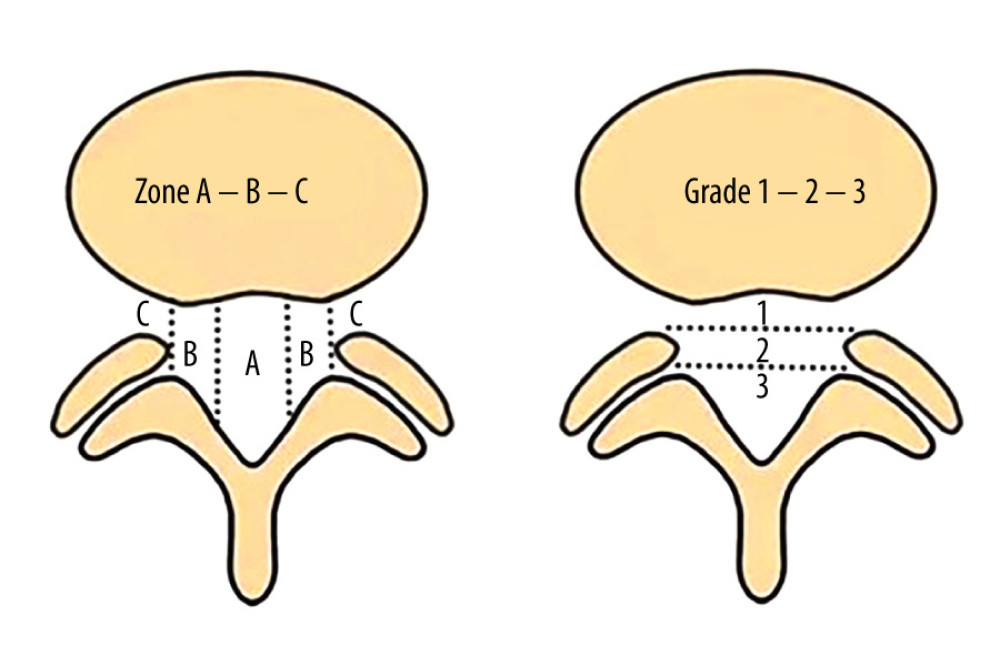MSU classification results from combination of size and location of LDH: grading LDH for size with growing impact on nerve compression from grades 1 to 3 and medial to lateral LDH location from zone A to zone C. MSU – Michigan State University; LDH – lumbar disc herniation.