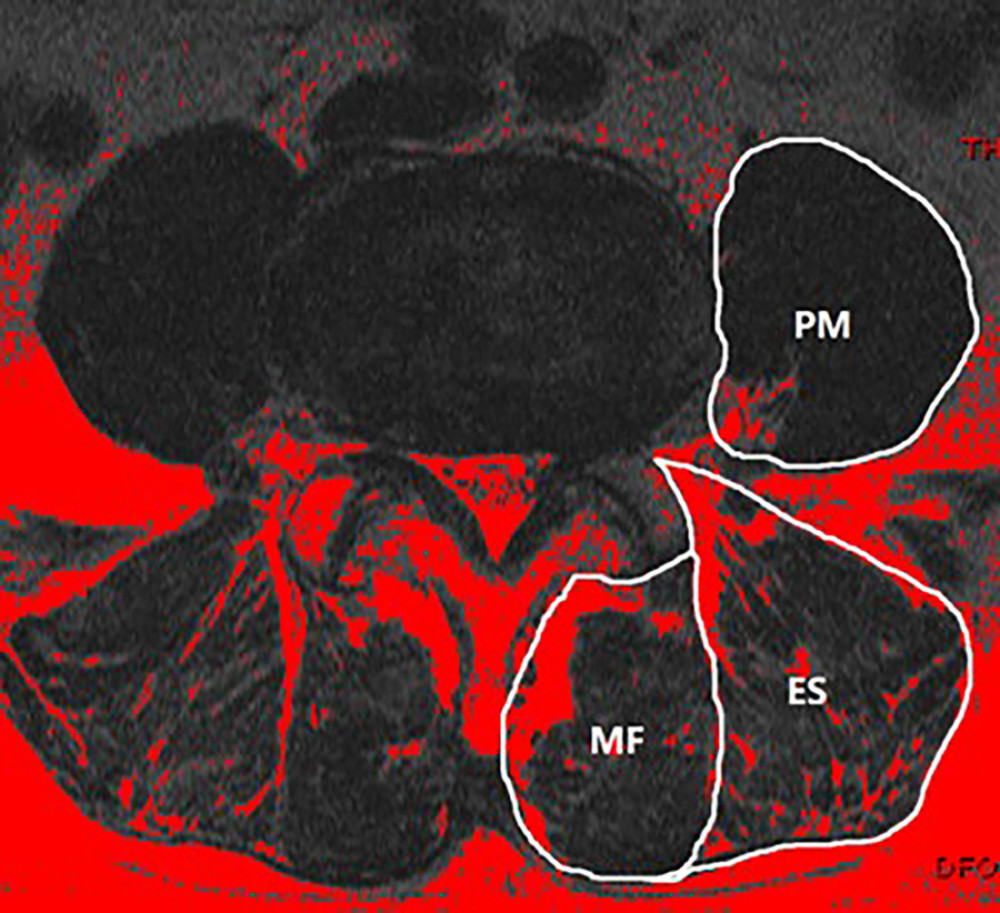 At the L4–L5 level, paraspinal muscle related parameters were measured using Image J software (version 1.43u).