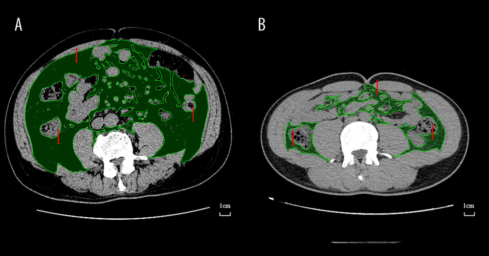 Preoperative Axial CT images of 2 different patients at the level of umbilicus used for evaluation of visceral obesity (represented). The green area indicated by the red arrow is the VFA. (A) Visceral obesity by VFA (B) Non-visceral obesity by VFA. CT – computed tomography; VFA – visceral fat area. Medcare software (AnyPACS2.0).