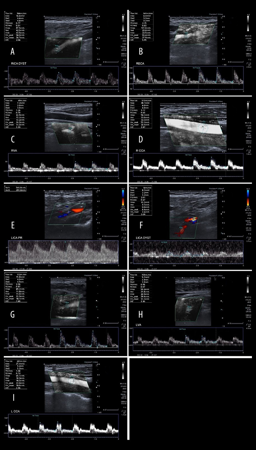 A 65-year-old patient with severe left ICA stenosis. Preoperative measurements: A – RICA flow 366 ml/min, B – RECA – flow 141 ml/min, C – RVA – flow 49 ml/min, D – RCCA flow 513 ml/min, E – LICA stenosis with flow velocity 5.42/2.92 m/s, F – distal part of the LICA with flow reduction 18 ml/min, G – LECA flow 172 ml/min, H – LVA flow 103 ml/min, I – LCCA flow 231 ml/min. Total preoperative CBF of 849 ml/min.