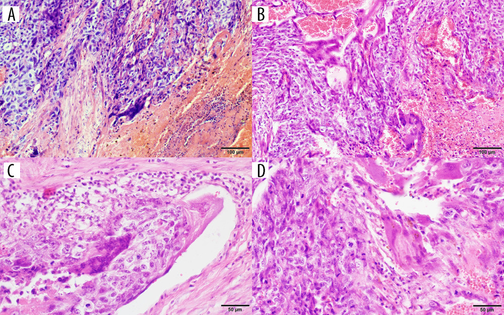 Photomicrographs of gestational choriocarcinoma. (A, B) Sheets of atypical cells, some large and multinucleated (syncytiotrophoblast), and smaller mononuclear cells (cytotrophoblast and intermediate trophoblast). Necrosis and hemorrhage; hematoxylin and eosin (H&E). Magnification ×200. (C) Vascular invasion of gestational choriocarcinoma; hematoxylin and eosin (H&E). Magnification ×400. (D) Marked cytological atypia, numerous mitoses; hematoxylin and eosin (H&E). Magnification ×400.
