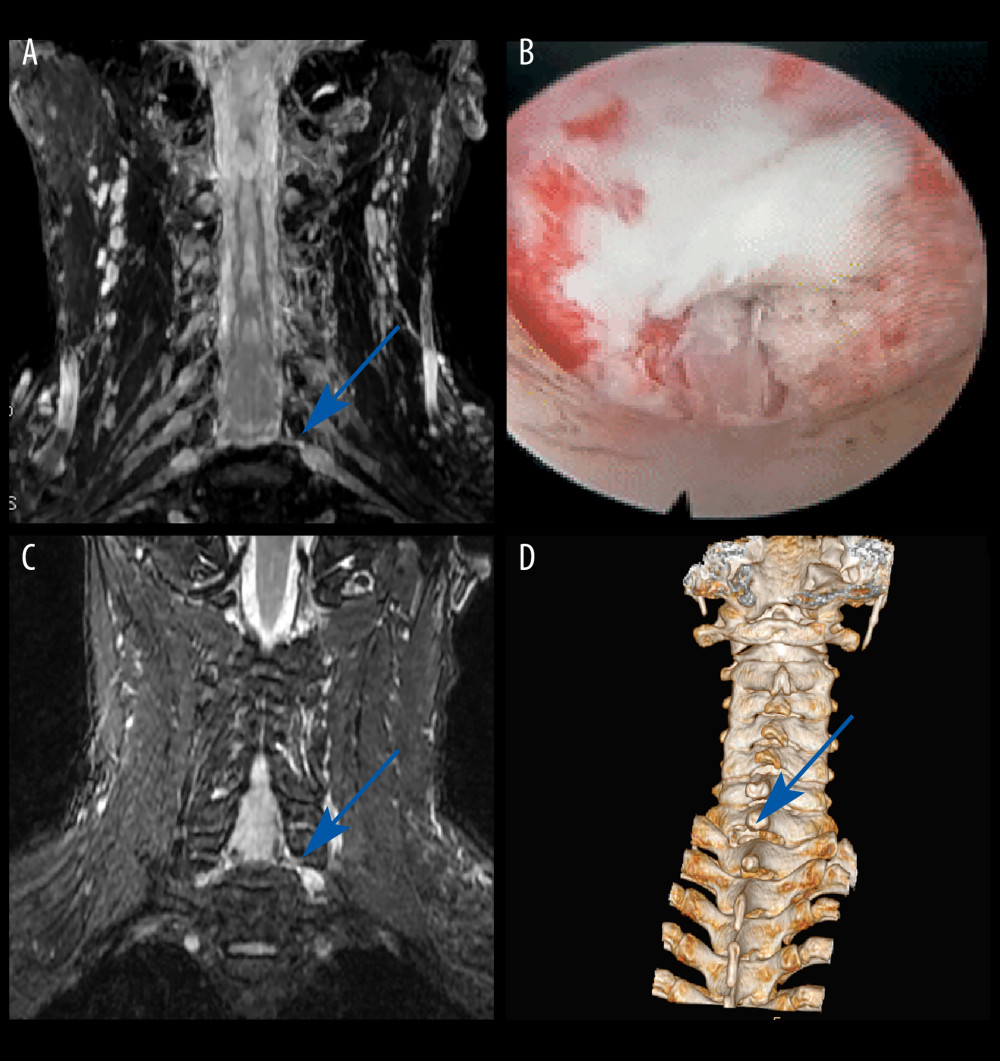Case 1: example of a typical case. (A) Coronal magnetic resonance image of 3-dimensional fast-field echo with water-selective excitation (CMRI) showed disc herniation at the left C7/T1 level, with nerve root filling defects (blue arrow). (B) Never root decompression performed, with good dural pulsation. (C) Postoperative CMRI showed good decompression of the left C8 nerve root (blue arrow). (D) Postoperative computed tomography image with appropriate windowing (blue arrow). Vue PACS, v12.2.6, Philips.