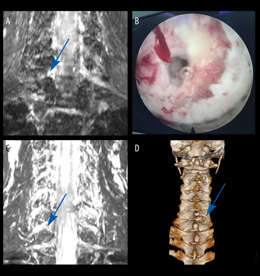 Case 2: example of a typical case. (A) Coronal magnetic resonance image of 3-dimensional fast-field echo with water-selective excitation (CMRI) showed disc herniation at the left C6/C7 level, with nerve root filling defects (blue arrow). (B) Surgical specimen of the removed intervertebral disc. (C) Postoperative CMRI showed good decompression of the right C7 nerve root (blue arrow). (D) Postoperative computed tomography image with appropriate windowing (blue arrow). Vue PACS, v12.2.6, Philips.