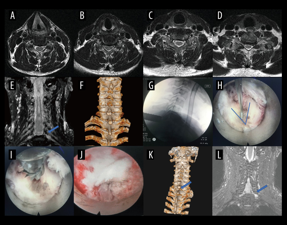 A typical case: case 1. (A-D) Cervical spine magnetic resonance imaging (MRI) showed no significant cervical spinal canal stenosis in segments C4/C5, C5/C6, C6/C7, and C7/T1. (E) Coronal MRI of 3-dimensional fast-field echo with water-selective excitation (CMRI) showed disc herniation at the left C7/T1 level, with nerve root filling defects (blue arrow). (F) Preoperative CT imaging. (G) After pre-operative localization by CMRI imaging, insertion of a working cannula. (H) Exposure of the V-point (arrow). (I) Using a high-speed drilling to remove the vertebral plate and articular process around the V-point. (J) Never root decompression performed, with good dural pulsation. (K) Postoperative computed tomography image with appropriate windowing (blue arrow). (L) Postoperative CMRI showed good decompression of the left C8 nerve root (blue arrow). Vue PACS, v12.2.6, Philips.