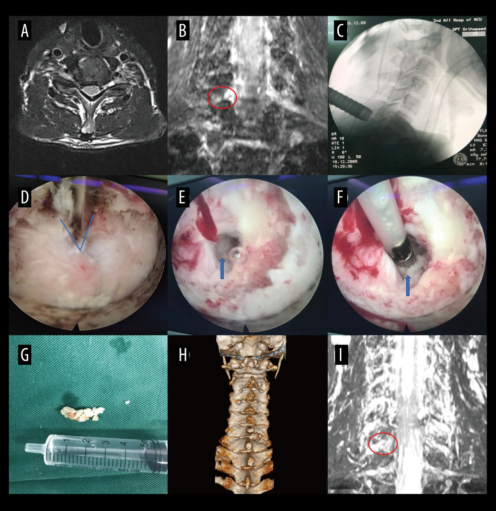 A typical case: case 2. (A) Cervical spine magnetic resonance imaging (MRI) showed no apparent cervical spinal canal stenosis in segments C6/C7. (B) Coronal MRI of 3-dimensional fast-field echo with water-selective excitation (CMRI) showed disc herniation at the left C6/C7 level, with nerve root filling defects (red circle). (C) After pre-operative localization by CMRI imaging, insertion of a working cannula. (D) Exposure of the V-point (blue arrow). (E) Exposure of the protruding intervertebral disc (blue arrow). (F) Surgical specimen of the removed intervertebral disc. (G) Degenerated disc tissue for comparison. (H) Postoperative computed tomography image with appropriate windowing. (I) Postoperative CMRI showed good decompression of the right C7 nerve root (red circle). Vue PACS, v12.2.6, Philips.
