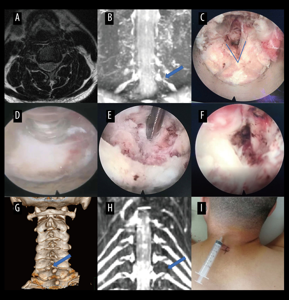 A typical case: case 3. (A) Cervical spine magnetic resonance imaging (MRI) showed no apparent disc herniation in segments C6/C7. (B) Coronal MRI of 3-dimensional fast-field echo with water-selective excitation (CMRI) showed foraminal stenosis at the left C6/C7 level (blue arrow). (C) Exposure of the V-point. (D, E) Pictures during endoscopic surgery. (F) Never root decompression performed. (G) Postoperative computed tomography image with appropriate windowing (blue arrow). (H) Postoperative CMRI showed good decompression of the left C7 nerve root (blue arrow). (I) Postoperative small incision. Vue PACS, v12.2.6, Philips.