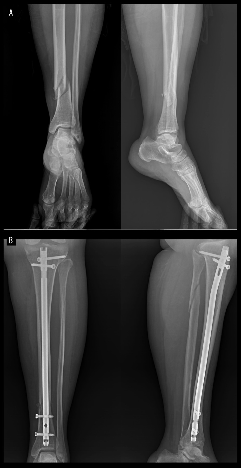 (A) Preoperative and (B) postoperative plain radiographic views of an extraarticular distal tibial fracture treated with interlocking intramedullary nailing (IMN).