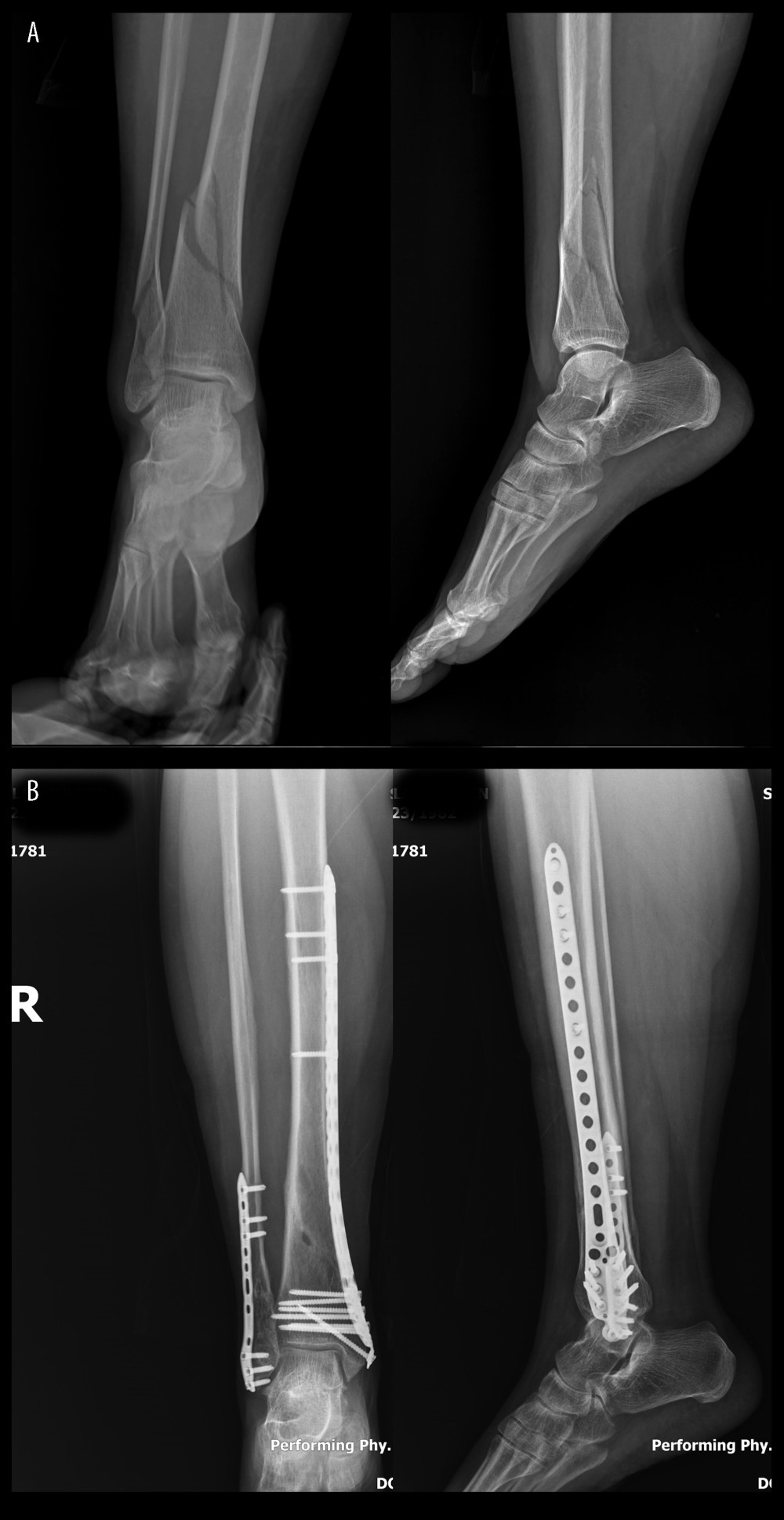 (A) Preoperative and (B) postoperative plain radiographic views of a extraarticular distal tibial fracture treated with minimally invasive plate osteosynthesis (MIPO).