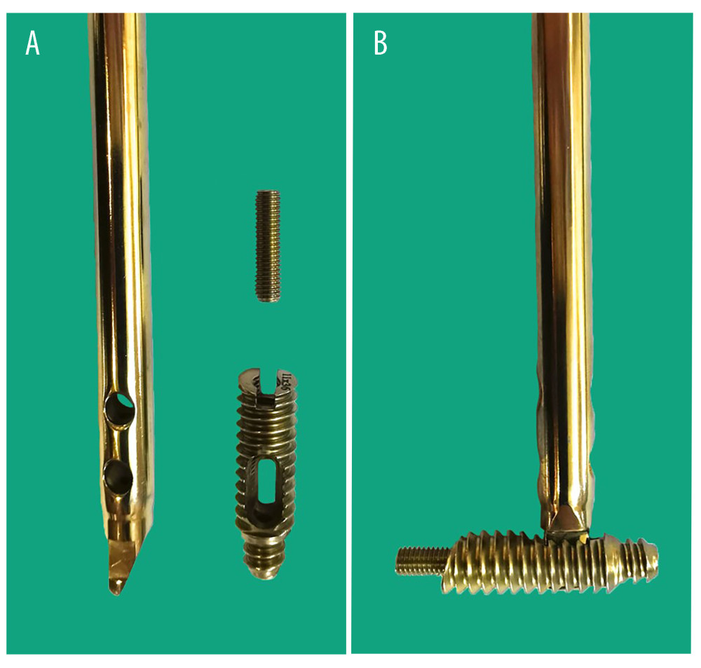 (A) The distal supportive bold locking screw (DSBLS), set screw, and set screw hole are shown. The distal end of the intramedullary nail has a unique design that allows contact with the DSBLS. (B) After the engagement, the design enables strong fixing of the nail within the DSBLS using a set screw. Figure 1 was taken with a smartphone and transferred to the computer. The background color was adjusted using Photoshop CC 2019.