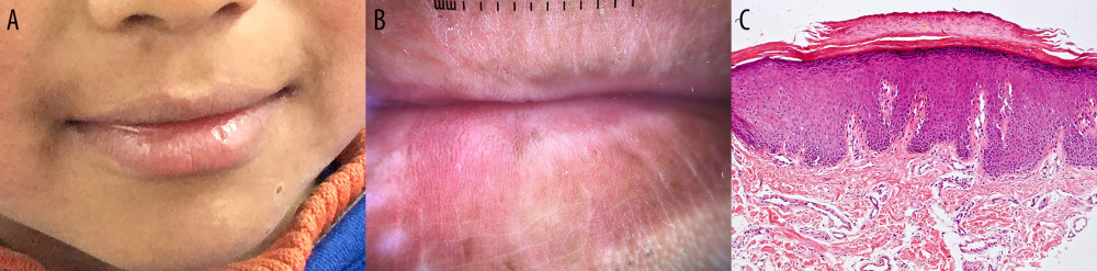 Lips of a 9-year-old male Indigenous patient with a Fitzpatrick Scale Score of IV (Rarely burn, tan more than average with ease). (A) Photograph of the clinical physical findings of desquamation on the lower lip. (B) Digital dermatoscopic photograph showed a white-red background color, monomorphous vessels pattern, and linear-irregular vessel morphology on the lower lip. (C) Photomicrograph of the lip biopsy with skin changes seen on dermoscopy. The histology shows increased basal cells and hyperplasia of the epidermis and parakeratosis of the surface keratin layer. Hematoxylin and eosin. Magnification ×40.